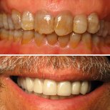 Resultados antes y después de la colocación de coronas dentales: sonrisa mejorada y dientes blancos