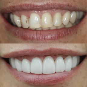 Resultados antes y después de la instalación de coronas dentales: mejora estética y color dental
