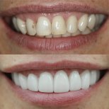 Resultados antes y después de la instalación de coronas dentales: mejora estética y color dental