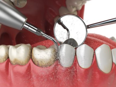 Resultado de limpieza profunda dental (raspado y alisado radicular) – dientes más limpios