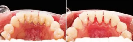 Resultados antes y después de limpieza profunda (raspado y alisado radicular) dientes inferiores