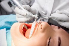 Limpieza dental profunda (raspado y alisado radicular) para mejorar la salud bucal
