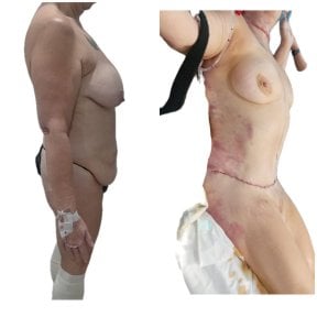 Before and after mommy makeover results at Hospital de la Familia, body contour improvement