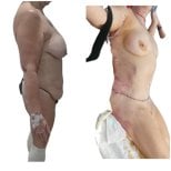 Before and after mommy makeover results at Hospital de la Familia, body contour improvement