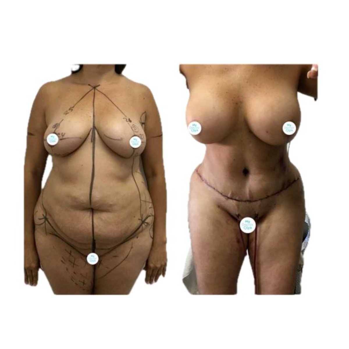 Resultados antes y después de mommy makeover en Hospital de la Familia, mejora corporal