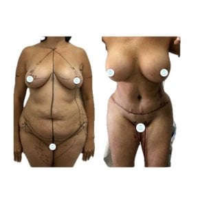 Before and after mommy makeover results at Hospital de la Familia, body contour improvement