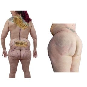 Mommy makeover before and after results at Hospital de la Familia, visible body contouring