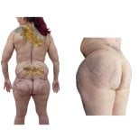 Mommy makeover before and after results at Hospital de la Familia, visible body contouring