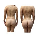 Mommy makeover before and after results at Hospital de la Familia, improved body contour