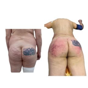 Before and after mommy makeover at Hospital de la Familia, visible buttocks contour result