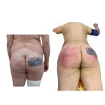 Before and after mommy makeover at Hospital de la Familia, visible buttocks contour result