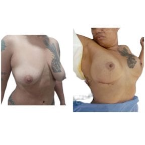 Before and after mommy makeover results at Hospital de la Familia, breast lift and contour