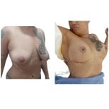 Before and after mommy makeover results at Hospital de la Familia, breast lift and contour