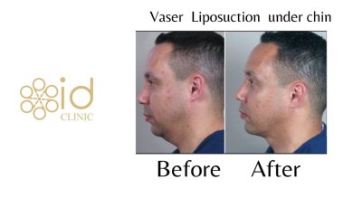 before-after photo podtazka-kozi-lica-fejslift
