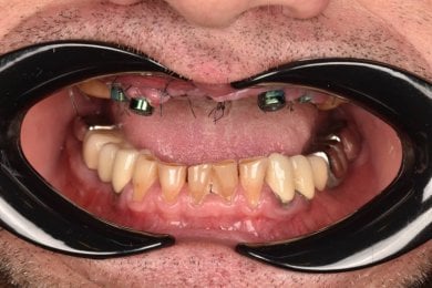 before-after photo all-on-4-dental-implants