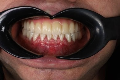 before-after photo all-on-4-dental-implants