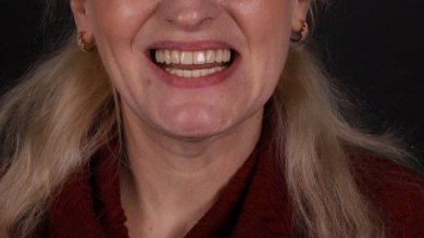 before-after photo dental-implant