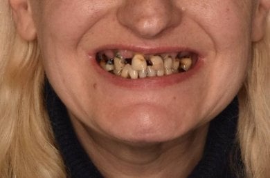 before-after photo dental-implant