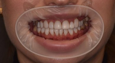 before-after photo installation-of-a-veneer