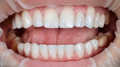 before-after photo installation-of-a-veneer