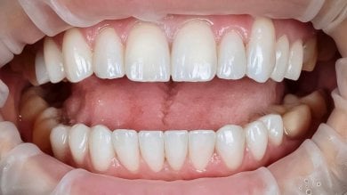 before-after photo denture