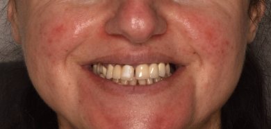 before-after photo all-on-4-dental-implants