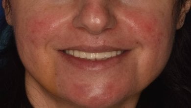 before-after photo all-on-4-dental-implants