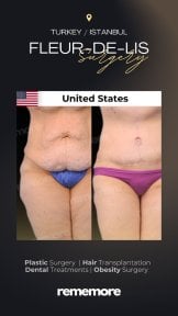 Before and after Fleur-de-Lis body lift results at Memorial Göztepe Hospital, abdomen contour