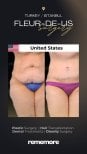Before and after Fleur-de-Lis body lift results at Memorial Göztepe Hospital, abdomen contour