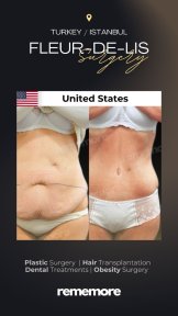 Before and after Fleur-de-Lis body lift results at Memorial Göztepe Hospital, abdomen contour
