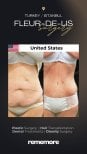Before and after Fleur-de-Lis body lift results at Memorial Göztepe Hospital, abdomen contour
