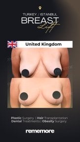 Before and after breast lift results at Memorial Göztepe Hospital, improved breast contour