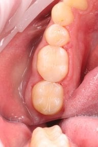 before-after photo dental-bonding