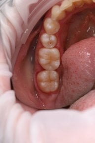 before-after photo dental-bonding