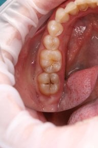 before-after photo dental-bonding