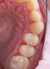 before-after photo dental-bonding
