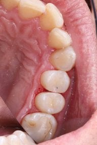 before-after photo dental-bonding