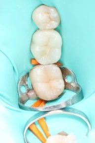 before-after photo root-canal-treatment
