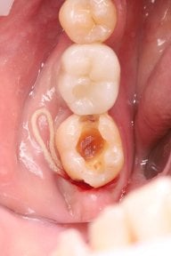 before-after photo root-canal-treatment