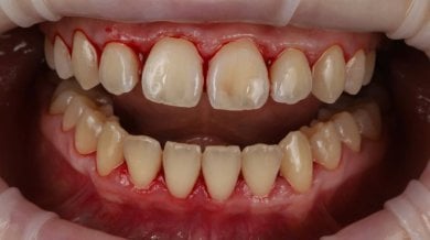 before-after photo tooth-whitening
