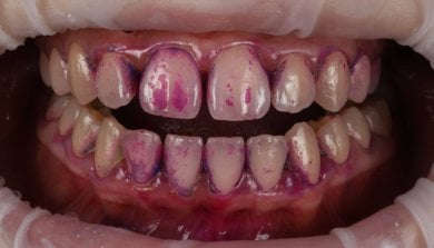before-after photo tooth-whitening