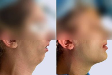 before-after photo tooth-extraction