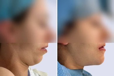 before-after photo tooth-extraction