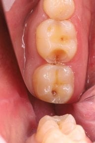 before-after photo tooth-extraction