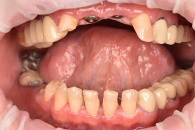 before-after photo tooth-extraction