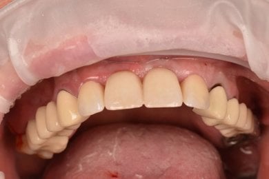 before-after photo tooth-extraction