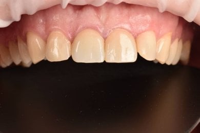 before-after photo denture