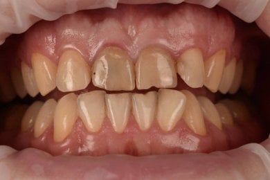 before-after photo denture