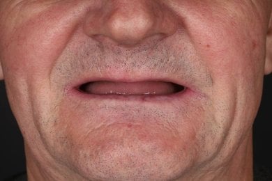 before-after photo denture