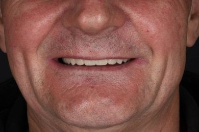 before-after photo denture